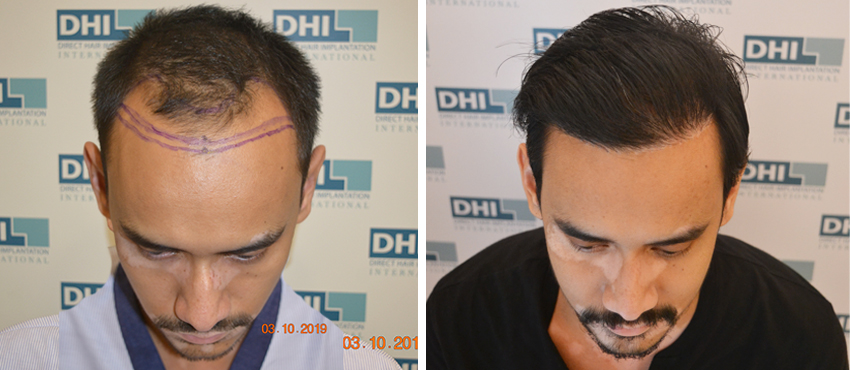 DHI before & after hair transplant results