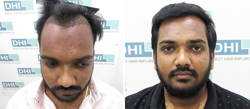 DHI before & after hair transplant results