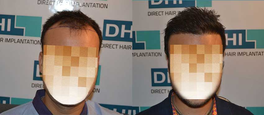 DHI before & after hair transplant results