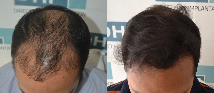 DHI before & after hair transplant results