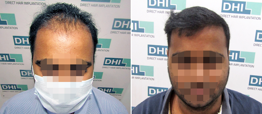 DHI before & after hair transplant results