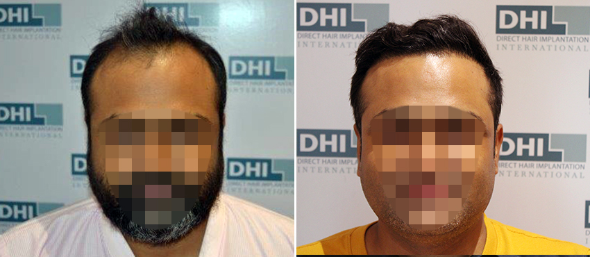 DHI before & after hair transplant results