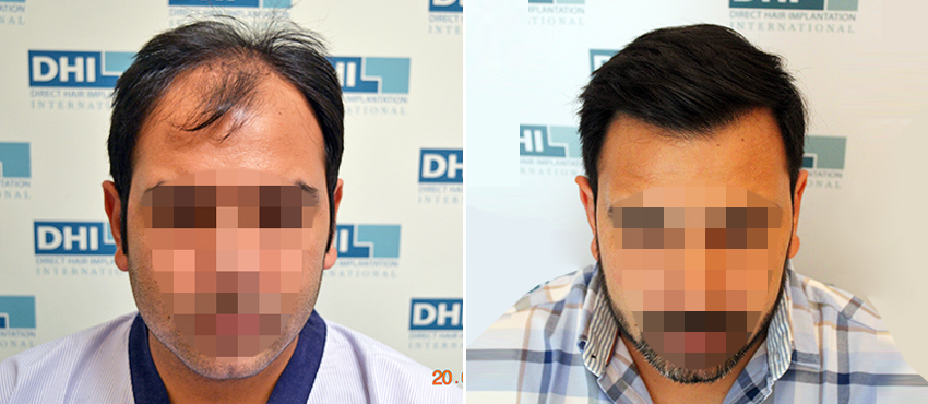 DHI before & after hair transplant results