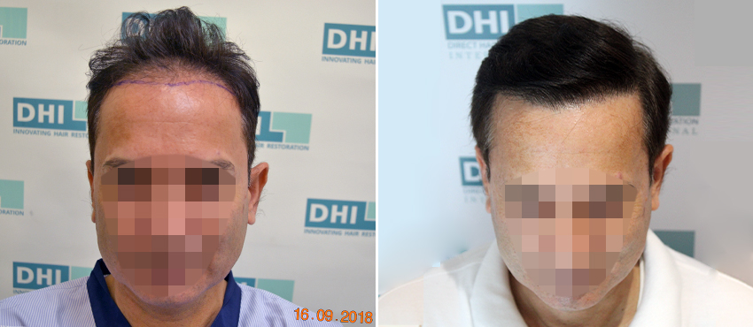 DHI before & after hair transplant results