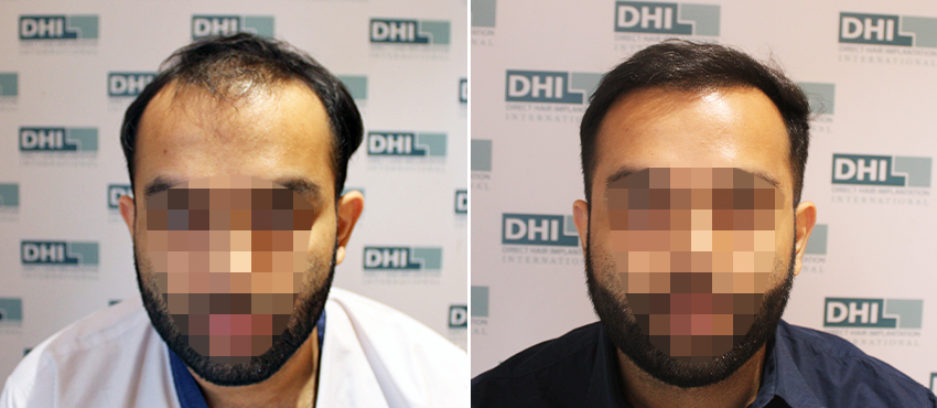 DHI before & after hair transplant results