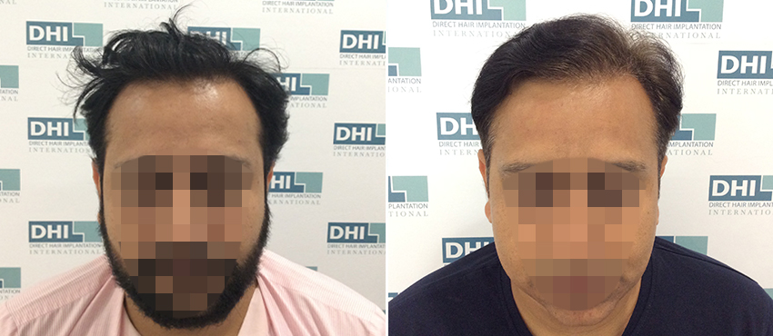 DHI before & after hair transplant results