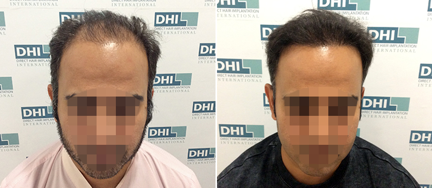 DHI before & after hair transplant results