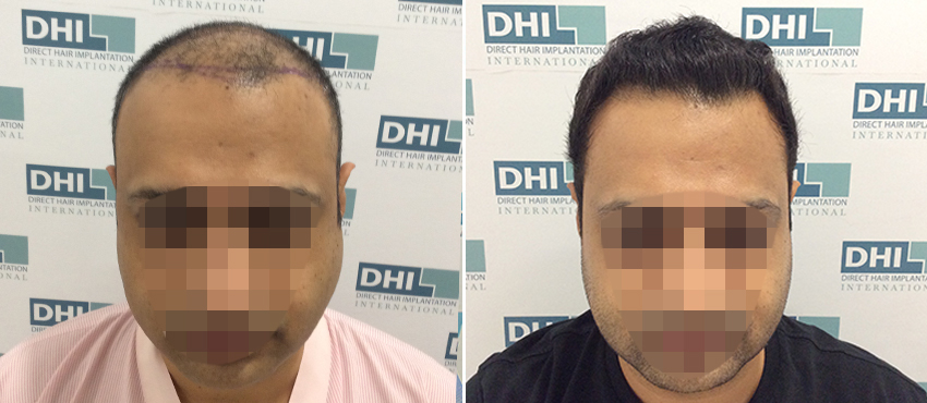 DHI before & after hair transplant results