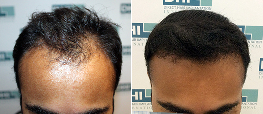 DHI before & after hair transplant results