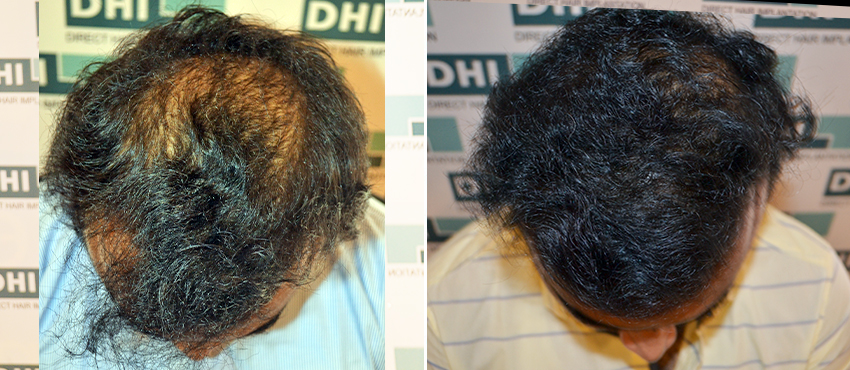 DHI before & after hair transplant results