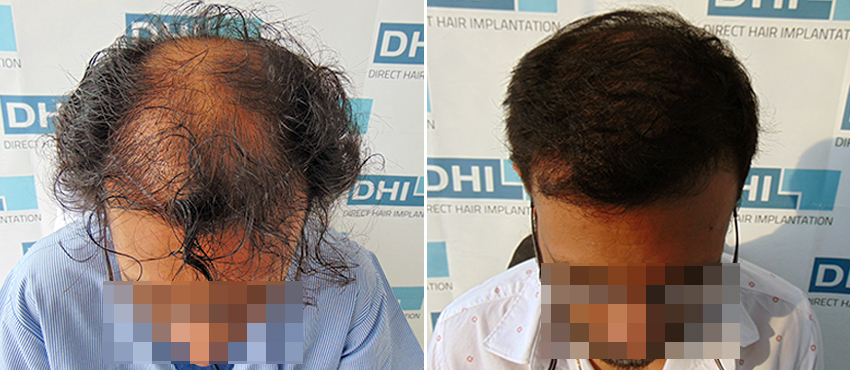 DHI before & after hair transplant results