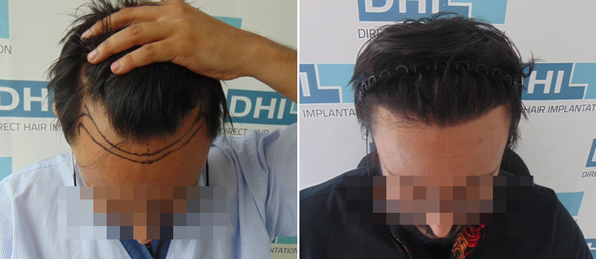 DHI before & after hair transplant results