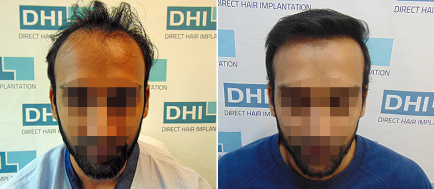 DHI before & after hair transplant results