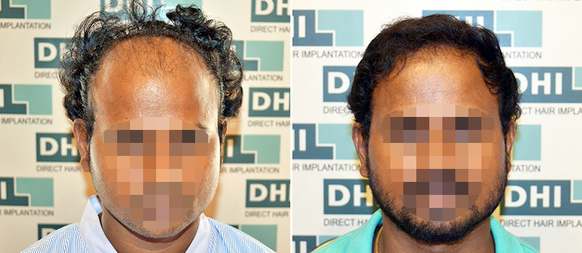 DHI before & after hair transplant results