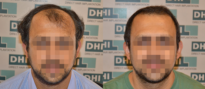 DHI before & after hair transplant results