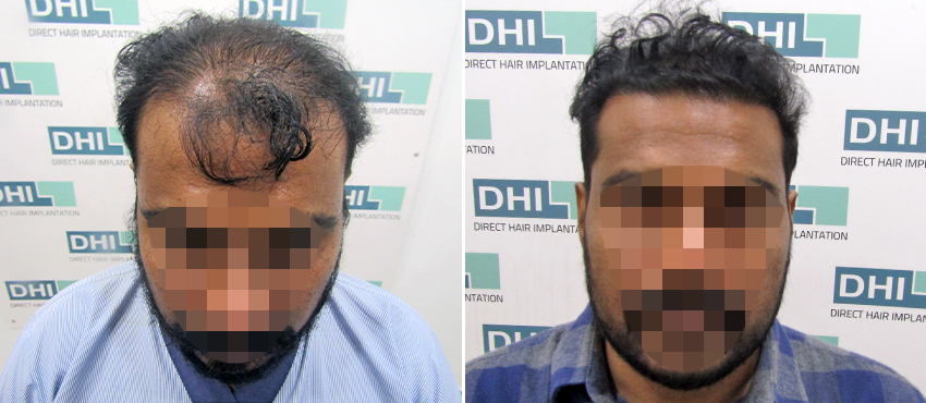 DHI before & after hair transplant results