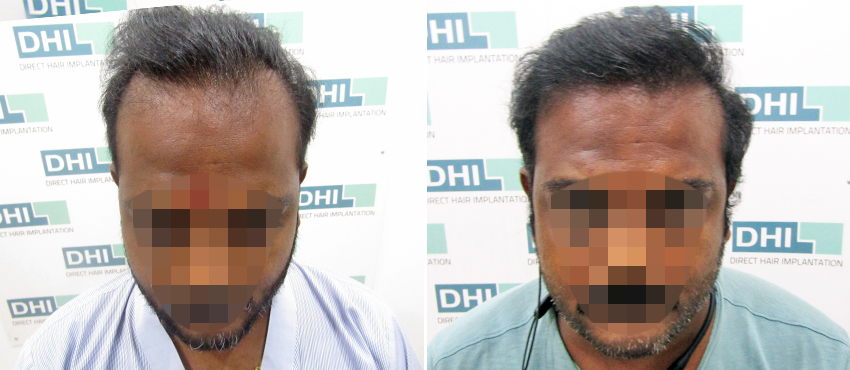 DHI before & after hair transplant results