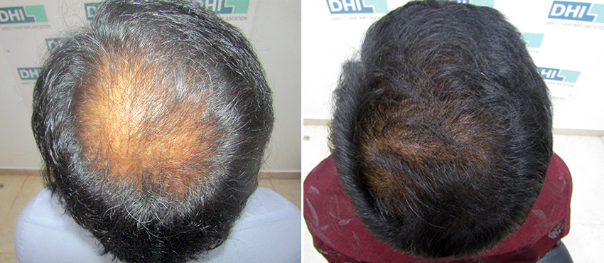 DHI before & after hair transplant results