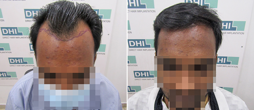 DHI before & after hair transplant results