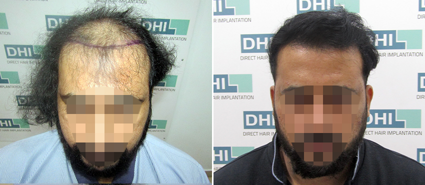 DHI before & after hair transplant results