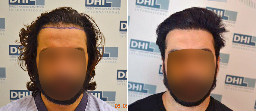 DHI before & after hair transplant results