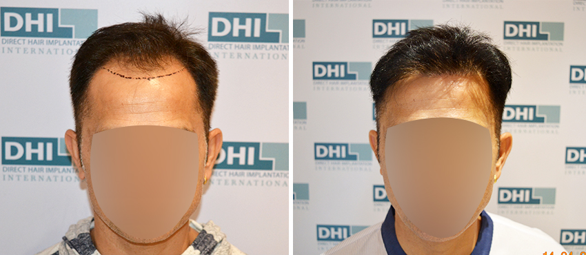 DHI before & after hair transplant results