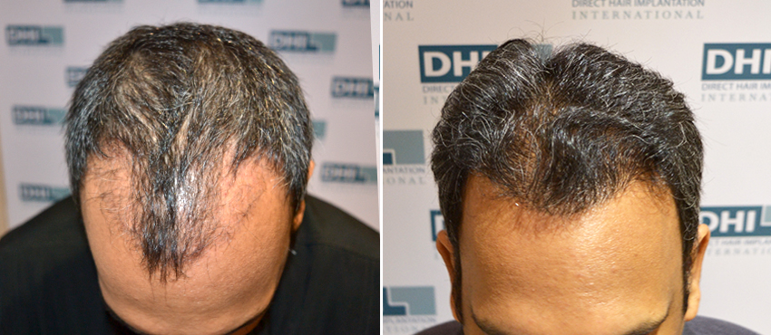 DHI before & after hair transplant results