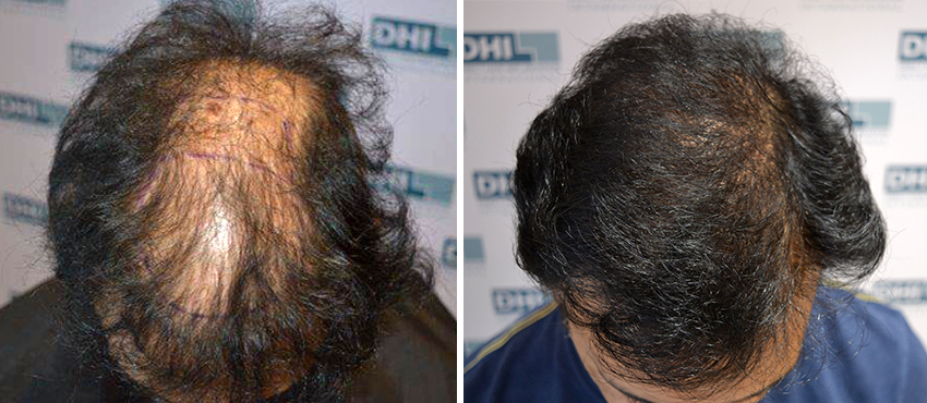 DHI before & after hair transplant results