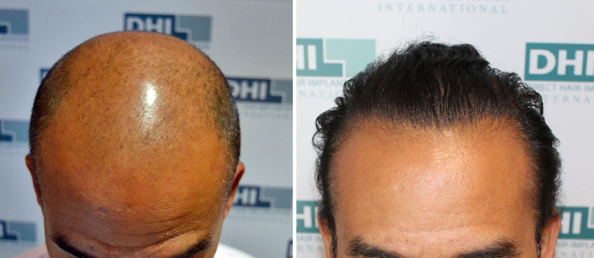 DHI before & after hair transplant results