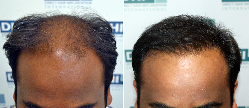 DHI before & after hair transplant results