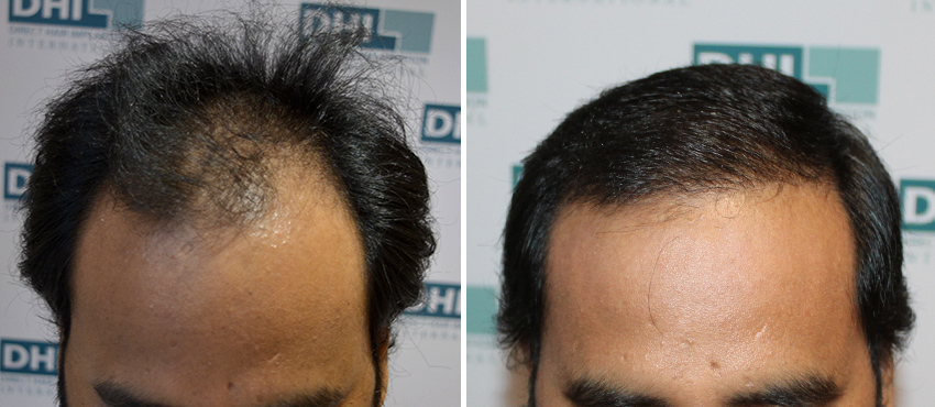 DHI before & after hair transplant results