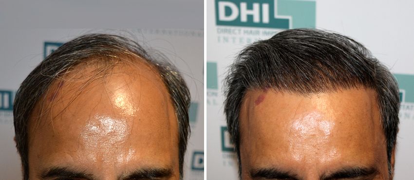 DHI before & after hair transplant results