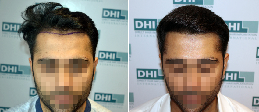 DHI before & after hair transplant results