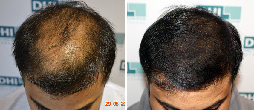 DHI before & after hair transplant results