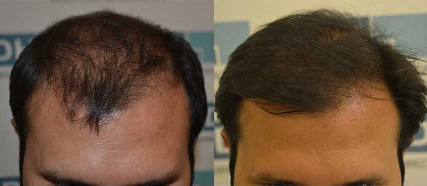 DHI before & after hair transplant results