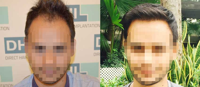 DHI before & after hair transplant results