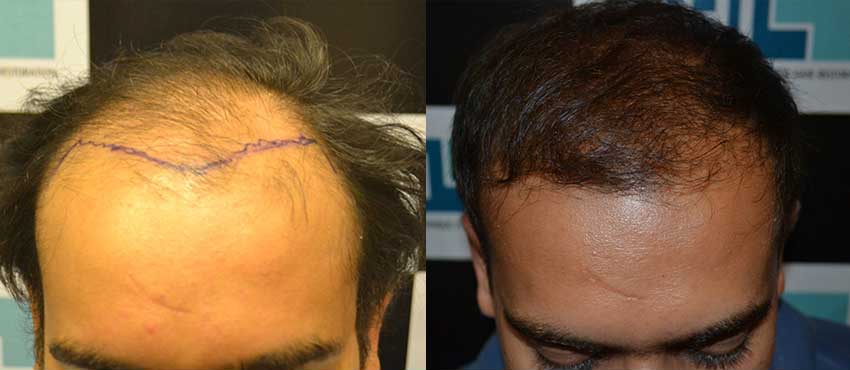 DHI before & after hair transplant results