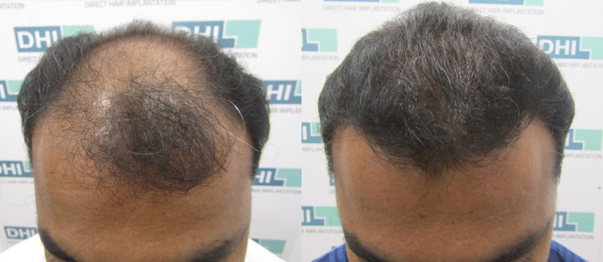 DHI before & after hair transplant results