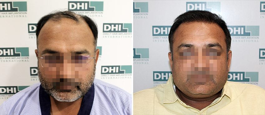 DHI before & after hair transplant results