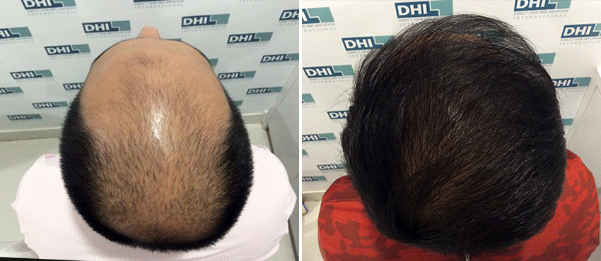 DHI before & after hair transplant results