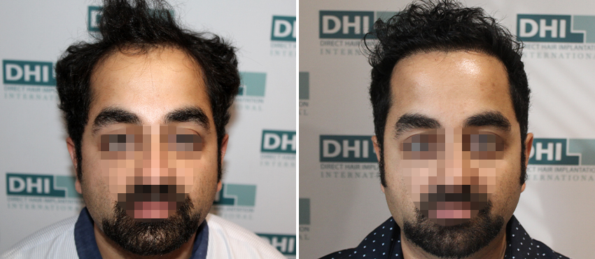 DHI before & after hair transplant results