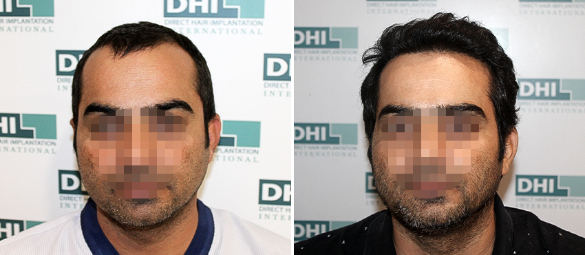 DHI before & after hair transplant results