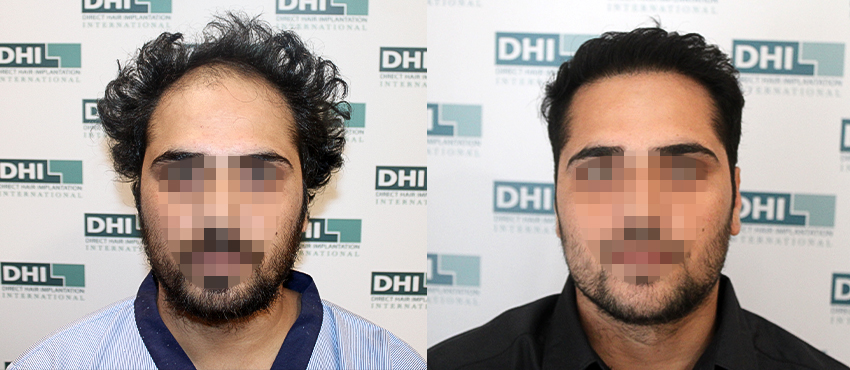 DHI before & after hair transplant results