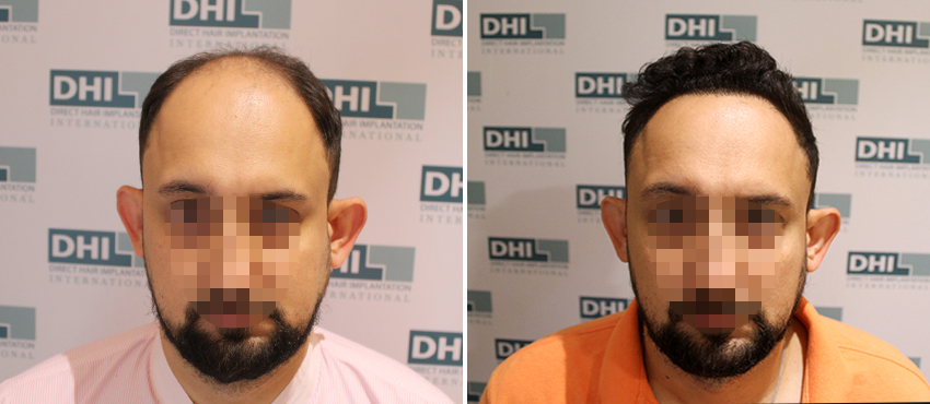 DHI before & after hair transplant results