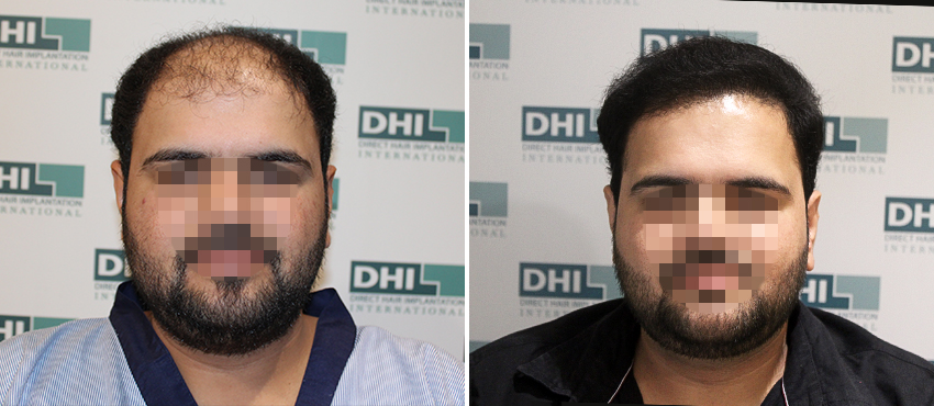 DHI before & after hair transplant results