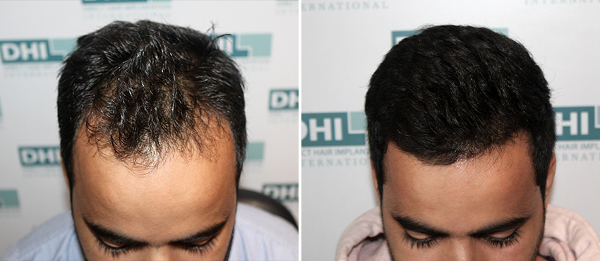 DHI before & after hair transplant results