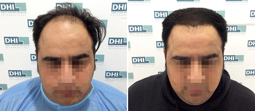 DHI before & after hair transplant results