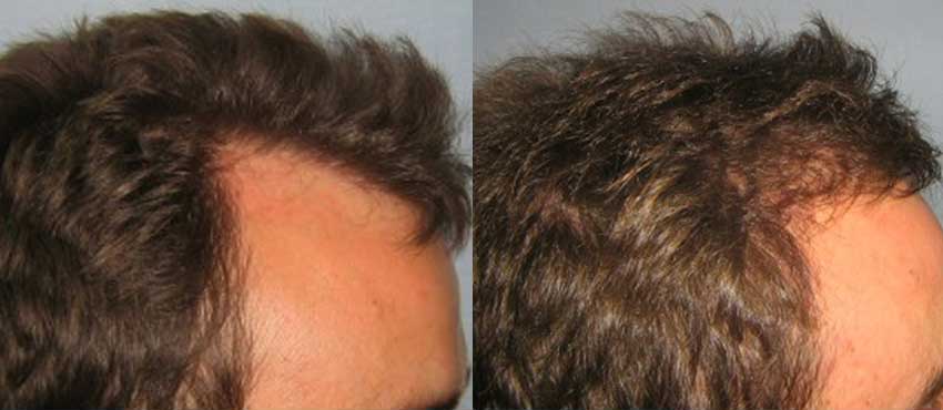 DHI before & after hair transplant results