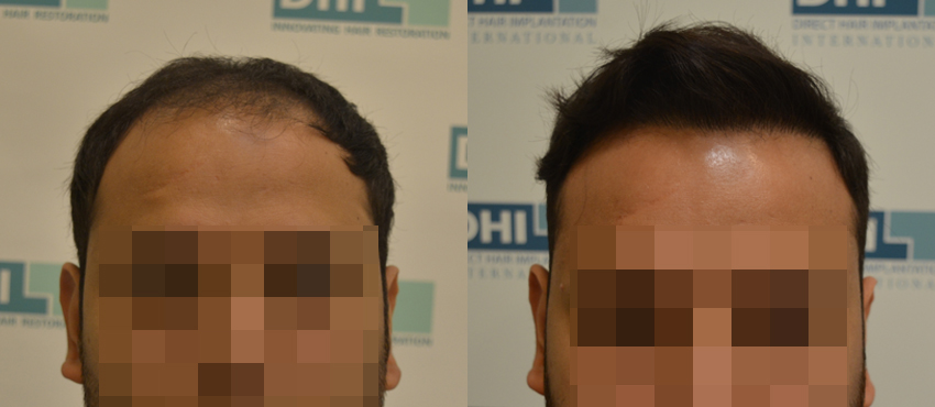 DHI before & after hair transplant results