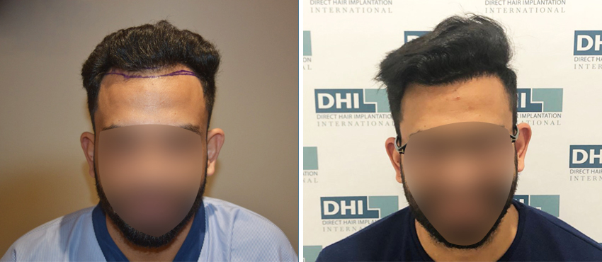 DHI before & after hair transplant results